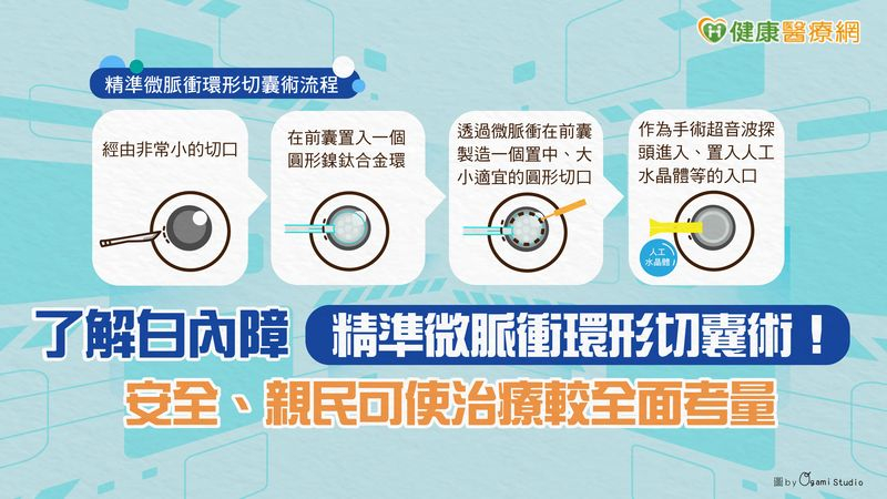 透過手術將白內障患者混濁的水晶體從囊袋中移除，並置入適當的人工水晶體可改善患者視力問題，在手術過程中「前囊撕除」是相當重要的步驟。