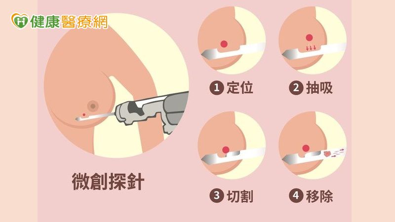 乳房腫瘤4種情況該切除!醫解析「微創手術適應症與優勢」 a5a1469d19071f2e294286bbff978261