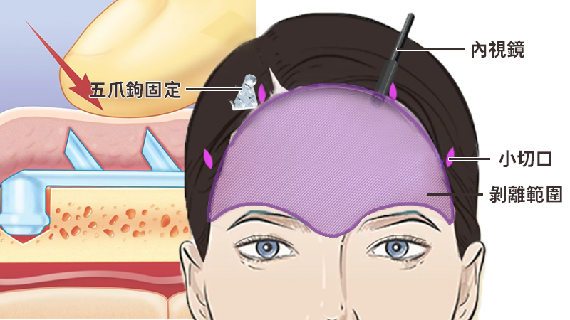 告別眉毛下垂與八字眉!內視鏡提眉手術揭密:3大優點+5大照護關鍵 454408d72c9d5743c9d8e7b51a75c475