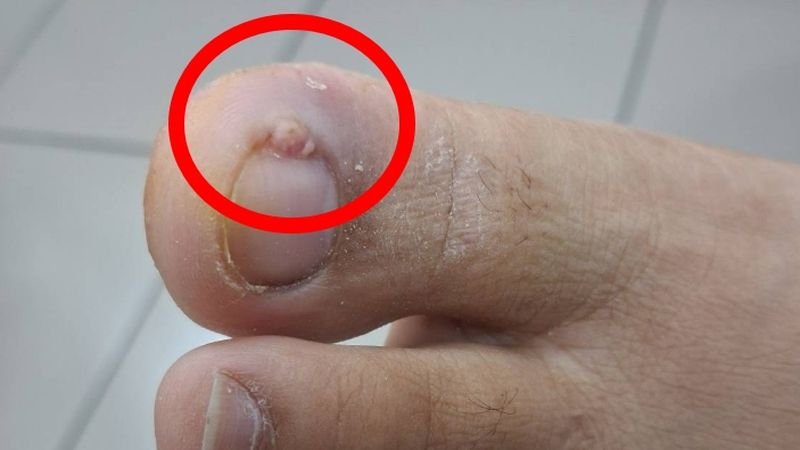 灰指甲又稱甲癬，是因黴菌感染指甲，導致指甲外觀改變。圖：樂生醫院提供