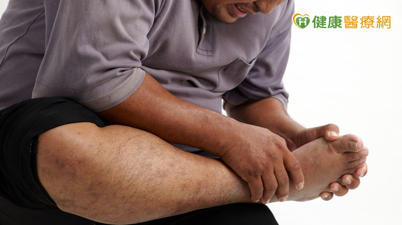 「腳腫如球」痛風如何治?基因檢測助攻 精準用藥更安心 d3497482610f60cac4732f9649fd812b l