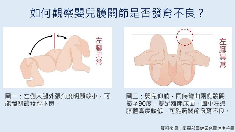 孩子換尿布有咔嗒怪聲?醫:恐是髖部問題 及早發現避免終生跛行 9c69ad31a0c09be421c110f82213f7f8