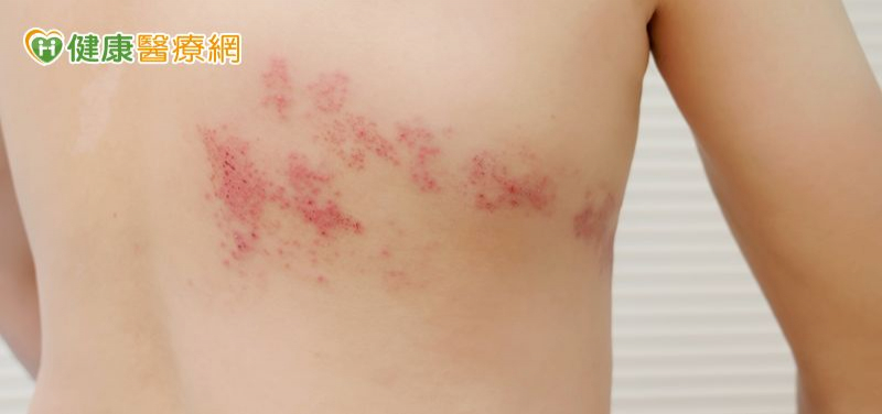 背痛到像被火燒竟是帶狀皰疹!醫:「這樣做」可大幅降低復發與後遺症 c0b3be86f49efb443257f579afa1e457 l