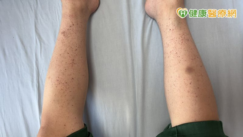 8歲童全身冒小血斑、剔牙大出血 竟是「免疫性紫斑症」險致命 fbd4669f477d186d0173e1fec918d9f2 l