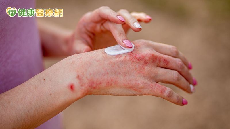 異位性皮膚炎怎麼用藥和吃穿?醫師一一告訴你 399966fd9f8c6da0140f8e3dbcbea50d l