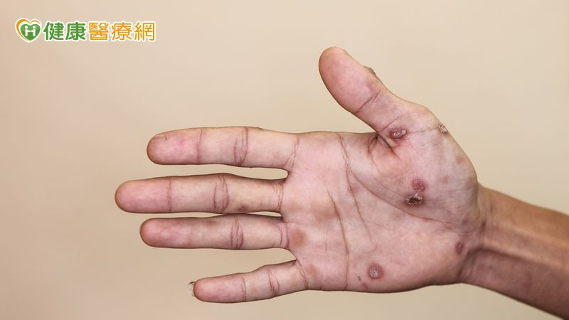 手腳紅斑不癢!他問AI竟罹「梅毒二期」 醫點頭揭成因 6c205b6094f3270bb24c29a2d7aa13e8 l