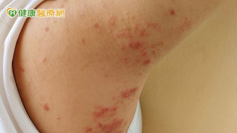 帶狀皰疹不僅痛得難以忍受，還可能留下長期神經痛，讓人生活大受影響。