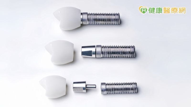 植牙需求增加，植牙前要仔細評估。