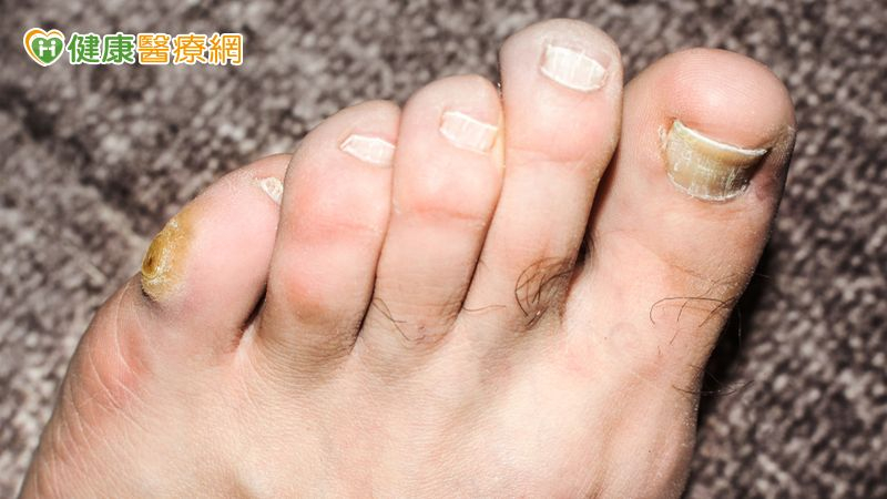 糖友穩定控制血糖卻忽略糖尿病足！醫及時救回避免截肢