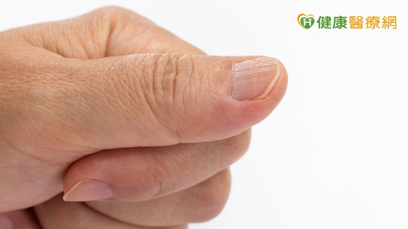 指甲不平整、直條紋現蹤？醫揭「甲下腫瘤警訊」
