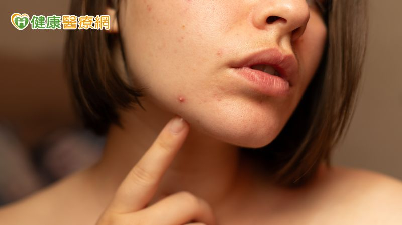 不只青春期！醫：痘痘也困擾上班族、更年期婦女　研究揭僅3成就醫