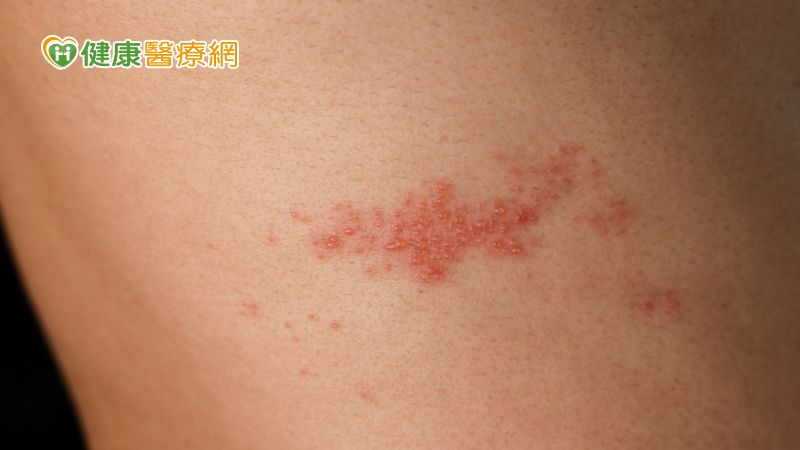 20歲女「眼生蛇」 　港皮膚科專科醫生拆解黃金救治72小時