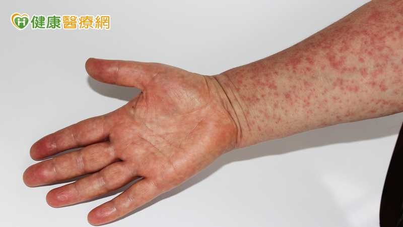 國際疫情持續！印尼返台男染麻疹　疾管署匡列384人監測至4／21