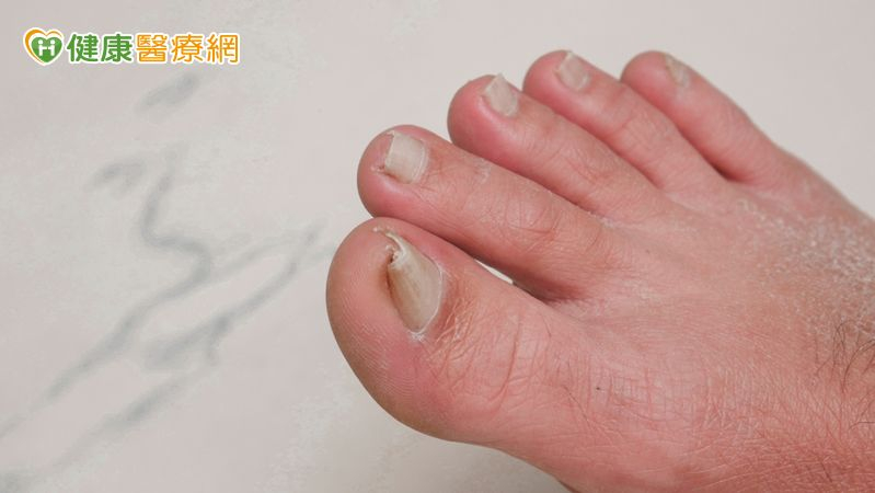 凍甲拔4次仍復發、「捲甲」痛到難穿鞋　甲床重建助甩寸步難行之苦