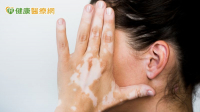 女大生臉部白斑引發人際焦慮　自體色素移植＋微創治療還本來面目