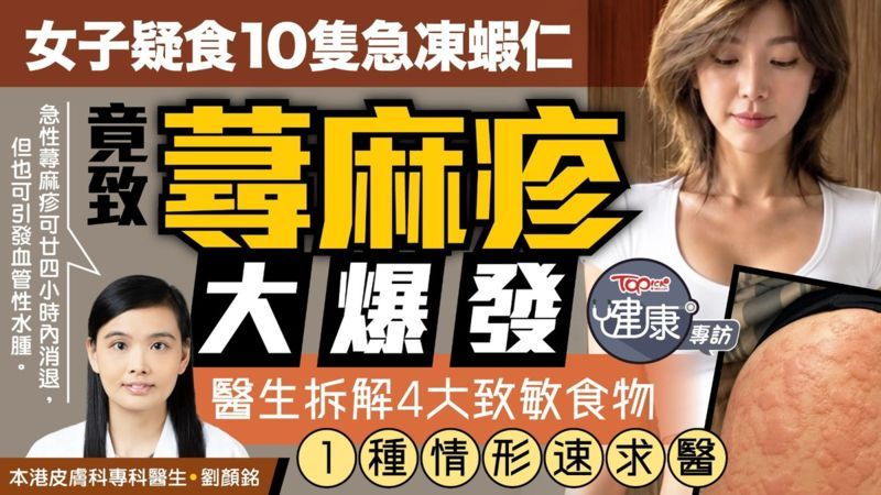 女子疑食10隻急凍蝦仁竟致蕁麻疹大爆發　醫生拆解4大致敏食物：1種情形速求醫