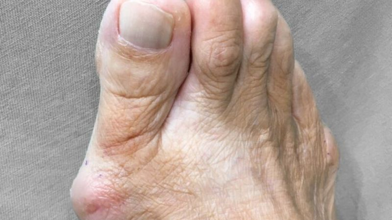「拇指外翻」許多人認為是老年人的足部疾病，但根據臨床觀察，有越來越年輕化的趨勢