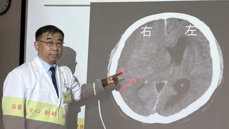 台中醫院神經外科主任陳典廷說明，患者因為左側手腳無力兩天就醫，發現右側腦出血。（記者陳金龍攝）