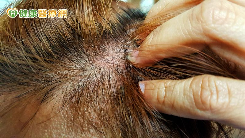 癌友頭皮長皮疹、潰瘍怎麼辦？護理師教正確照護4步驟