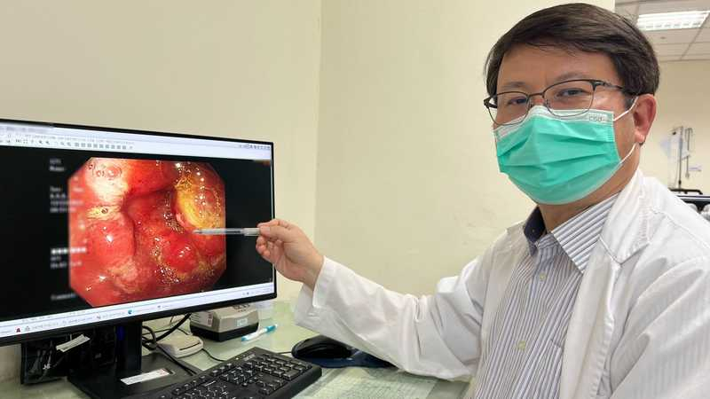 68歲患者長期胃脹氣，台中光田綜合醫院大甲院區肝膽腸胃科醫師蘇劍生安排胃鏡檢查，發現胃部黏膜異常，後續病理切片診斷為胃癌第3期。 （記者陳榮昌攝）