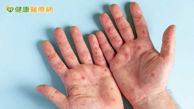 衛生福利部疾病管制署提醒，今年國內累計已有7例腸病毒感染併發重症，其中5例感染D68型，呼籲幼童如經醫師診斷感染腸病毒後出現重症前兆，家長應立即送往大型醫院治療。