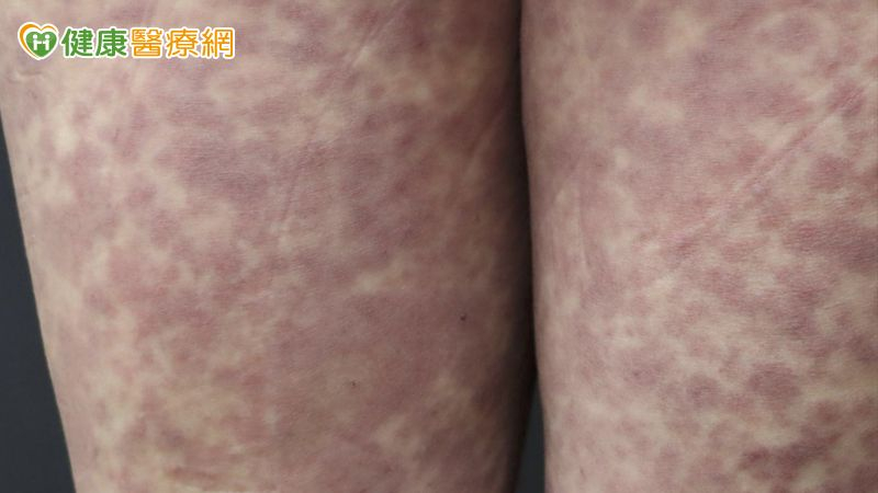 37歲女吃藥發燒出疹　檢測揪出複方藥「這成分」致敏