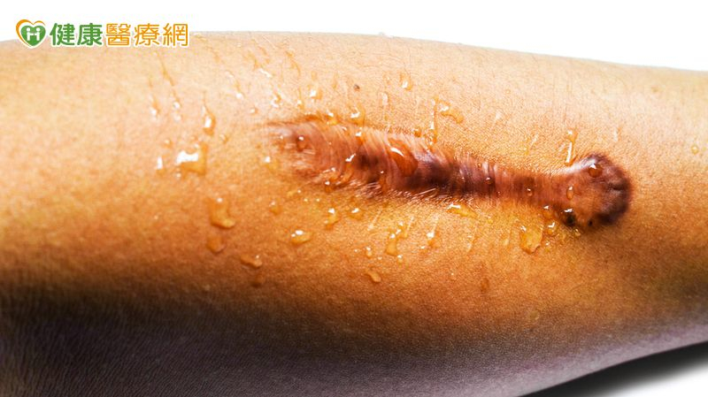 愛美穿耳洞竟長出肉塊　傷口癒合異常恐是「蟹足腫」