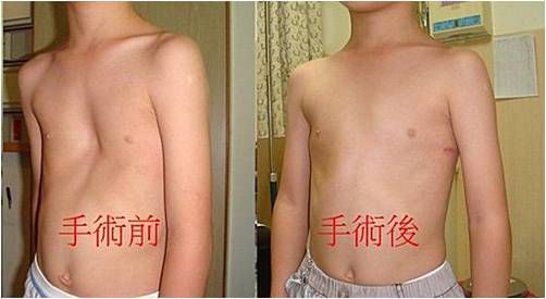 男健身 女豐胸 難改善漏斗胸!! 