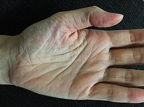 少女雙手皺巴巴竟是魚鱗癬上身 健康醫療網 健康養生新聞資訊網路媒體