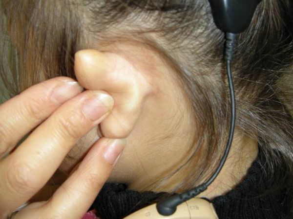 人工耳蜗 让听障宝也可正常「听说」