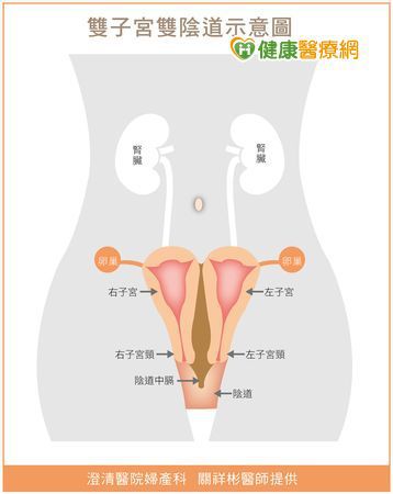 双子宫双阴道女 仅单边罹子宫颈癌