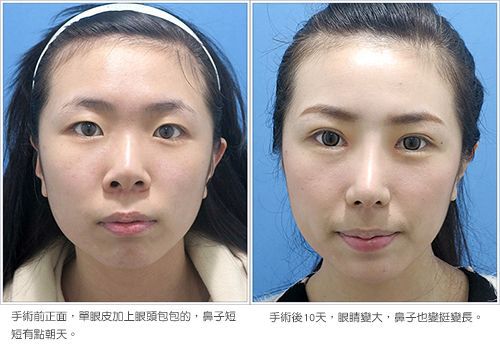 打造甜美系女孩娃娃電眼 韓式三段式隆鼻 健康醫療網 健康養生新聞資訊網路媒體