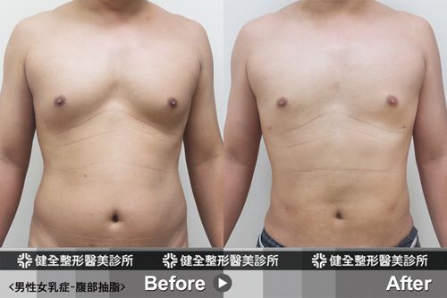 太胸 男性挺罩不住嗎 你的男人味因為突出的上圍而相形失色嗎 健康醫療網 健康養生新聞資訊網路媒體